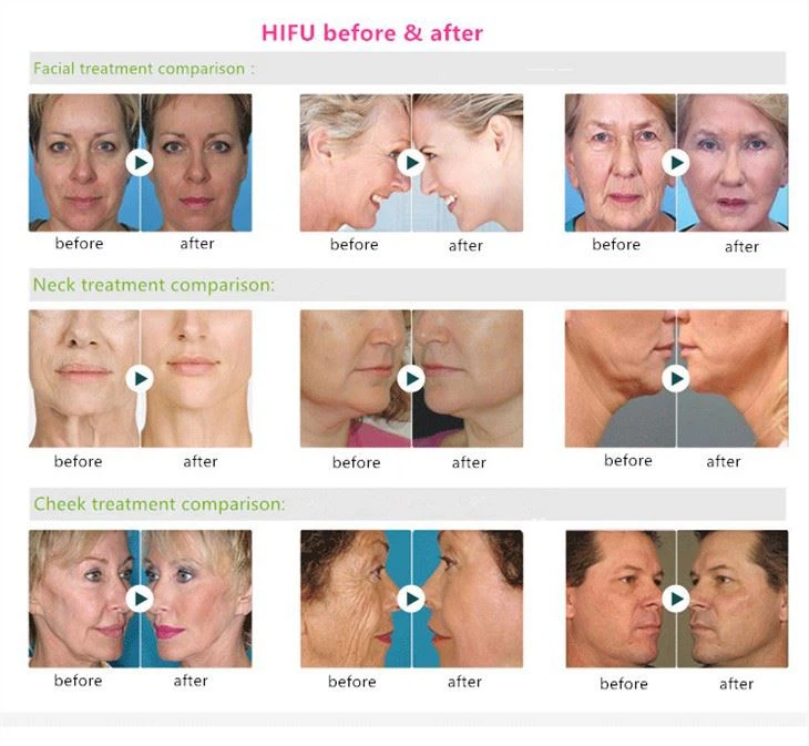 4D HIFU Facelift Body Slimming Machine