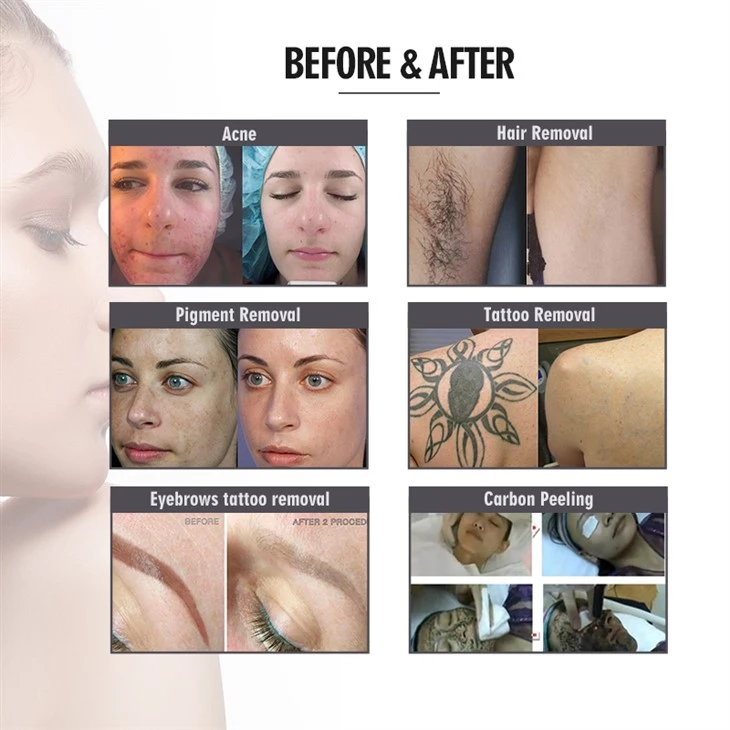 DPL Skin Rejuvenation Hair Removal Machine